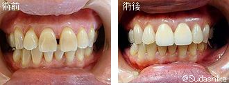 大阪市東成区 森ノ宮・玉造の歯医者 須田歯科　ホームホワイトニングとハイブリッドレジンを併用し、審美性を改善したケースの画像