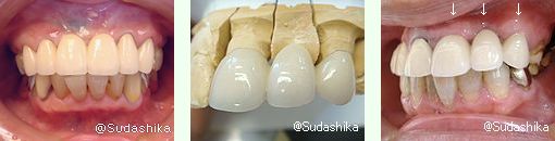 大阪市東成区 森ノ宮・玉造の歯医者 須田歯科　メタルボンドブリッジの画像
